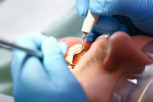Best Emergency Root Canal Treatment in Indianola, WA